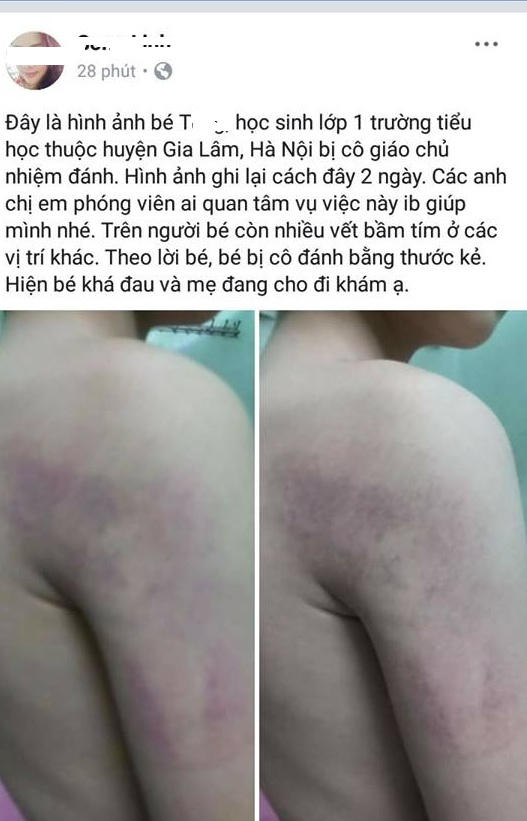 Hình ảnh cháú T trên người có nhiều vết bầm tím được cho là cô giáo chủ nhiệm tên H. đánh được chia se trên mạng xã hội.