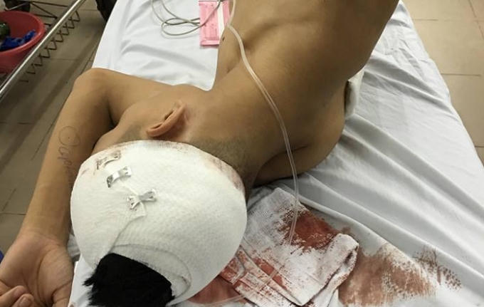 Một trong ba nạn nhân đang được điều trị tại bệnh viện Việt Đức.