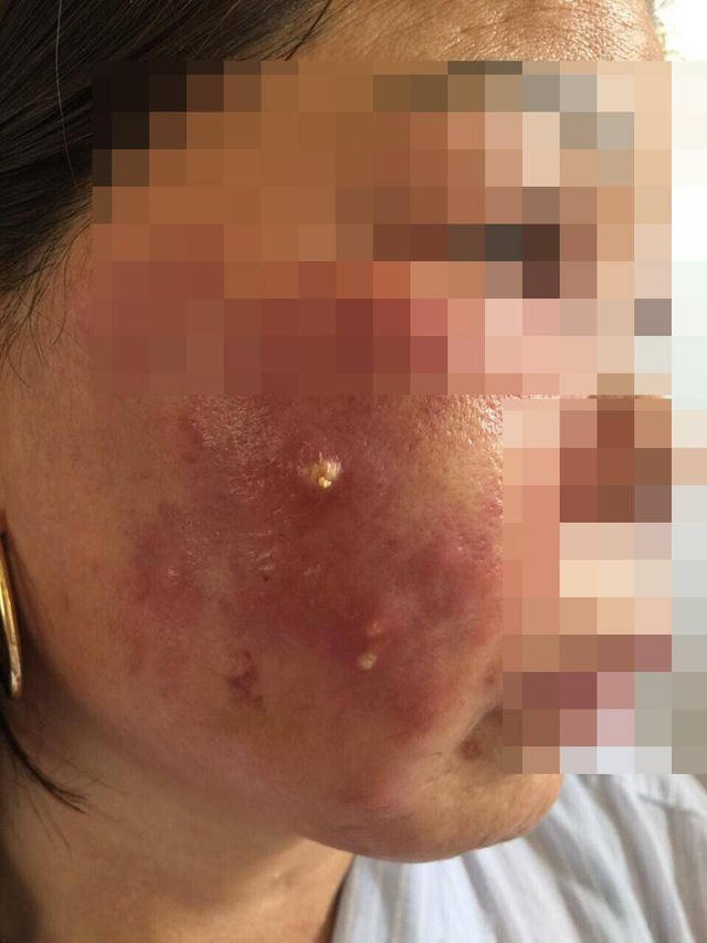 Bệnh nhân đã phải nhập viện vì biến chứng nhiễm trùng da sau khi bôi và tiêm thuốc trắng da.