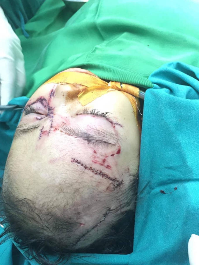 V&ugrave;ng mặt b&eacute; g&aacute;i với nhiều vết thương do bị ch&oacute; cắn.