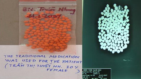 HÌnh ảnh thuốc nam không rõ nguồn gốc, phim X-quang cho thấy thuốc nam này nhiễm chì ra sao. Ảnh: Bệnh viện Bạch Mai