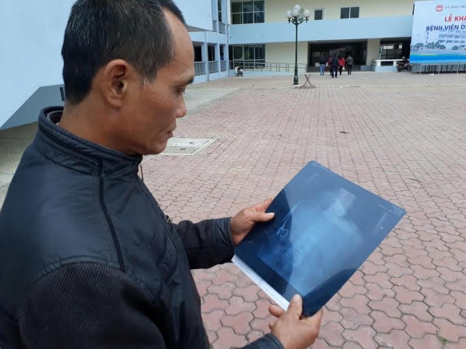 Ông Ma Văn Nhật chưa hết bàng hoàng khi biết vật thể được dùng trong y khoa vẫn nằm trọn trong bụng mình cách đây 18 năm.
