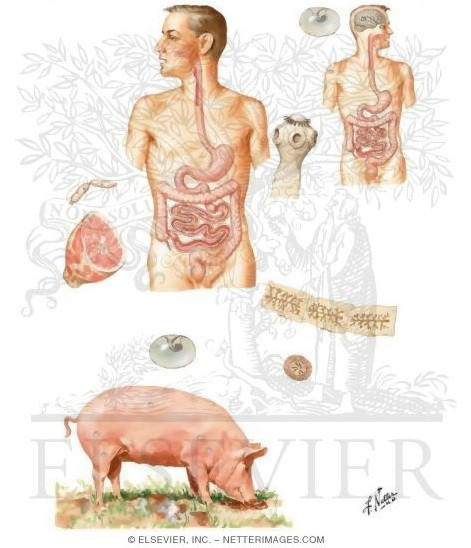 Bệnh lợn  gạo có tên khoa học Cysticercus cellulosae là bệnh gây ra bởi ấu trùng sán dây lợn, có tên khoa học Toenia solium.