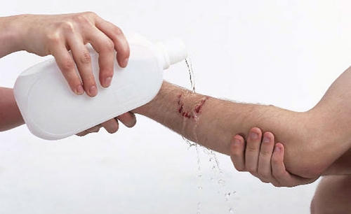 Khi bị chó, mèo cắn cần rửa ngay thật kỹ vết thương bằng xà phòng dưới vòi nước mạnh ít nhất là 5 phút. Ảnh: minh họa