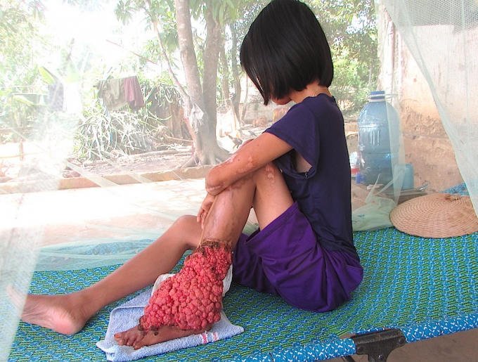 Hàng ngày Thanh phải chịu trăm ngàn nỗi đau vì căn bệnh quái ác hành hạ.