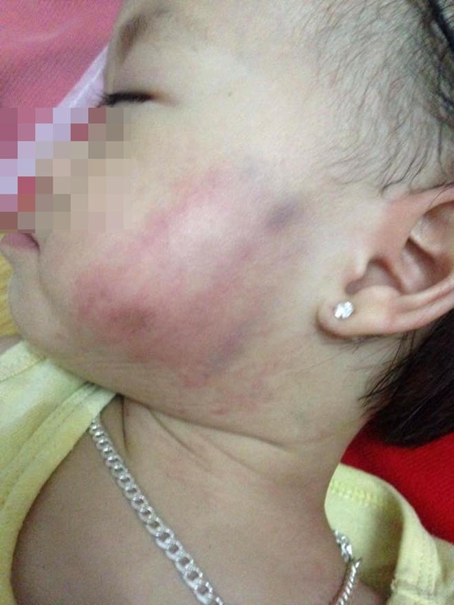 Cháu P. nghi bị cô giáo đánh bầm tìm mặt. Ảnh: Internet