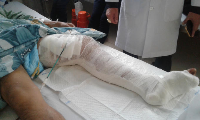 Phẫu thuật nối th&agrave;nh c&ocirc;ng đứt động mạch đ&ugrave;i cho bệnh nh&acirc;n