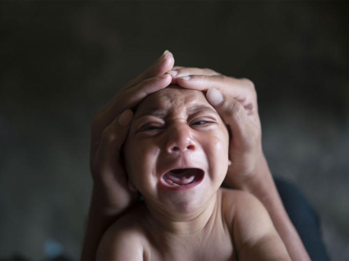 WHO cũng đã khẳng định có mối liên quan giữa virus Zika với chứng đầu nhỏ ở trẻ sơ sinh và Hội chứng viêm đa rễ dây thần kinh.