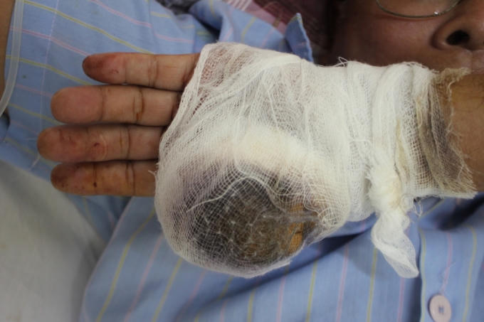 Ngón tay cái bàn tay trái của ông Lộc bị chém đứt lìa.