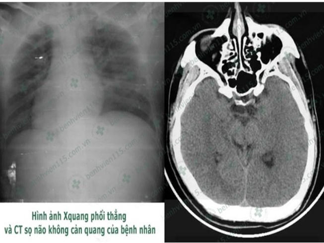 Kết quả chụp CT cho thấy anh N. bị hôn mê sâu. (Ảnh do BV cung cấp)