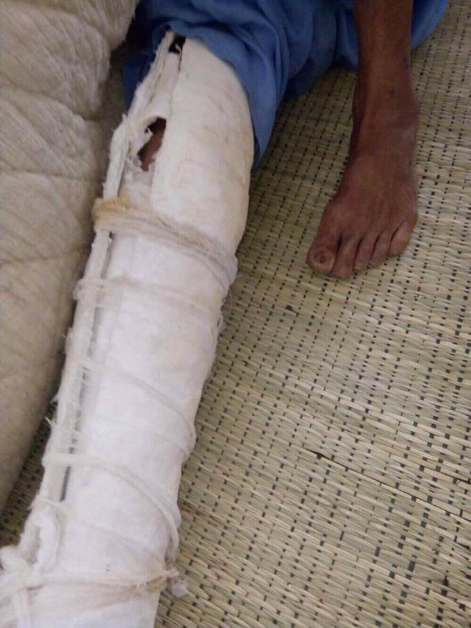Một chân của ông N phải bó kín do bị con trai đánh.