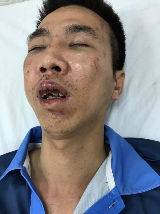 Vết thương của nạn nhân sau khi bị hành hung, Ảnh : FB Phạm Thái Dương.