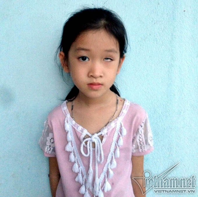 Sau tai nạn, mắt trái của em bị mù vĩnh viễn.