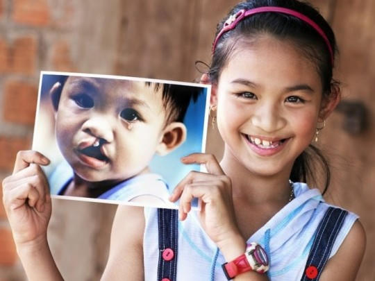 Trung bình mỗi năm có trên 3.00 trẻ sơ sinh bị sứt môi, hở hàm ếch.