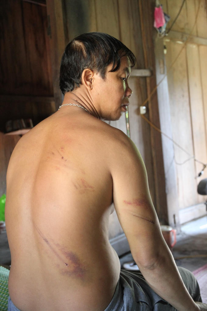 Những vết bầm tím trên người anh Hồ Văn Đan do bị bảo vệ mỏ vàng đánh đập