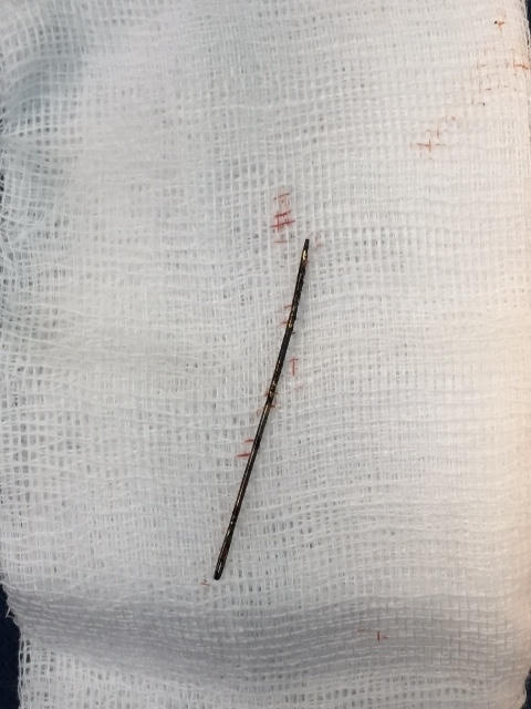 Chiếc kim khâu dài 4cm ở trong lồng ngực bé 3 tuổi suốt 2 năm. Ảnh: BVCC