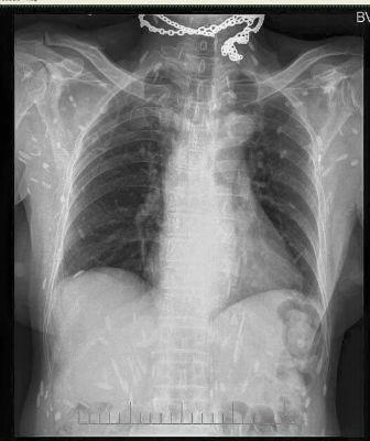 H&igrave;nh ảnh bệnh nh&acirc;n bị nhiễm s&aacute;n đ&atilde; bị v&ocirc;i h&oacute;a xuất hiện tr&ecirc;n cản quang.