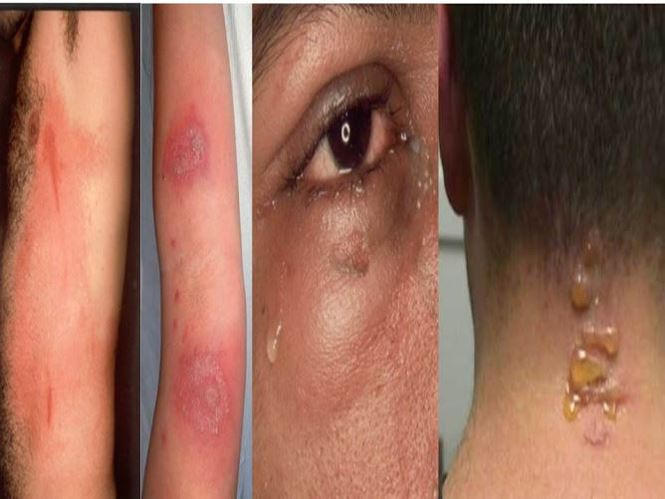 Tổn thương tr&ecirc;n da của bệnh nh&acirc;n do bị kiến ba khoang đốt