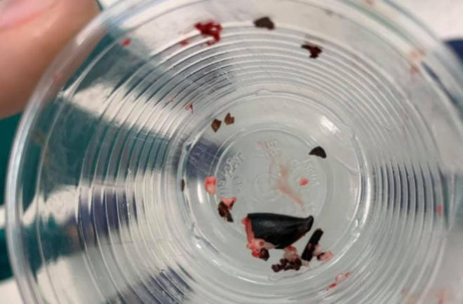 Hạt sa pô chê được bác sĩ kẹt nát mới lấy ra được. Ảnh: BVCC