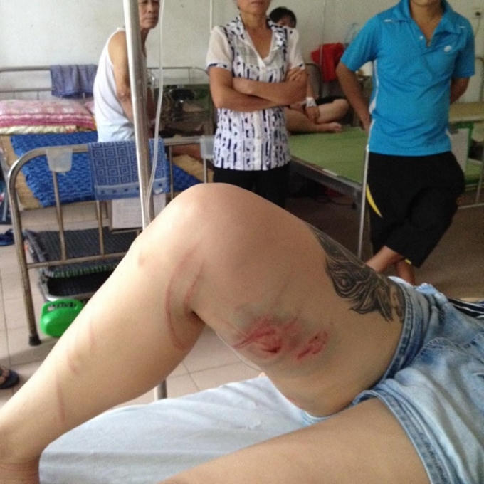 Cô gái bị bạo lực, bầm dập toàn thân phải nằm viện. (Ảnh: Facebook).