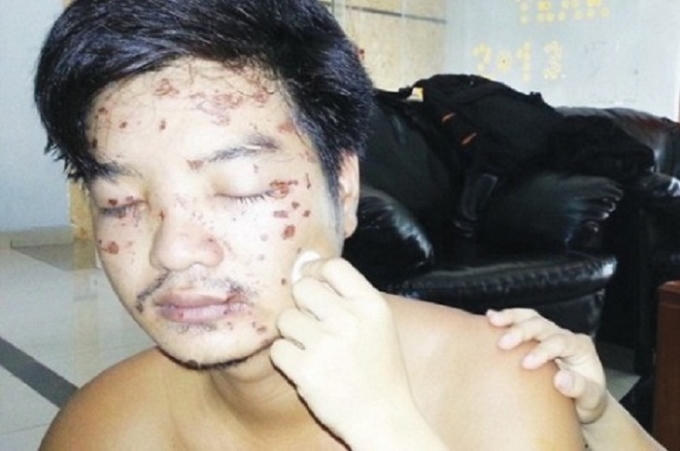 Anh Trung với những vết bỏng trên mặt do phải “lĩnh” cả ca axít của những kẻ côn đồ. (Ảnh: Công lý)
