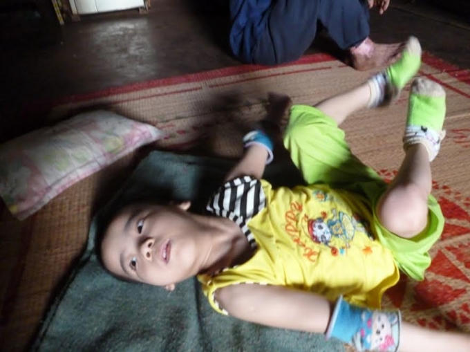 Những cháu bé bị bại não bẫm sinh tại xã Bom Bo( huyện Bù Đăng, tỉnh Bình Phước) bị bà Tuyển ăn chặn tiền hỗ trợ trong thời qua.