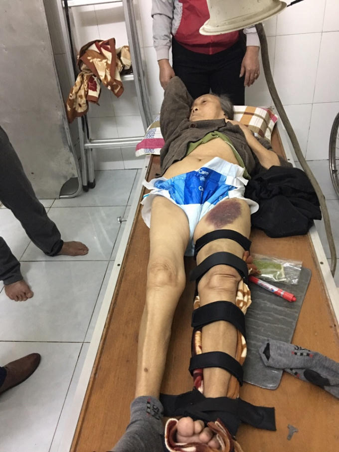 Bệnh nhân gãy cổ xương đùi đến bó lá tại nhà thuốc.