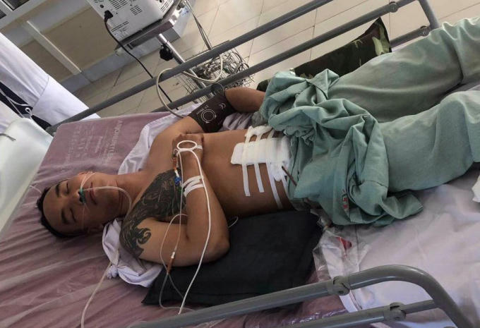 Anh Nguyễn Gia Định người bị bắn xuyên bụng đạn găm vào cột sống.