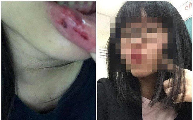 Hình ảnh T.D tố bị anh rể đánh.