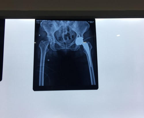 Ảnh XQ chụp khớp nhân tạo của bà Mai sau khi phẫu thuật.