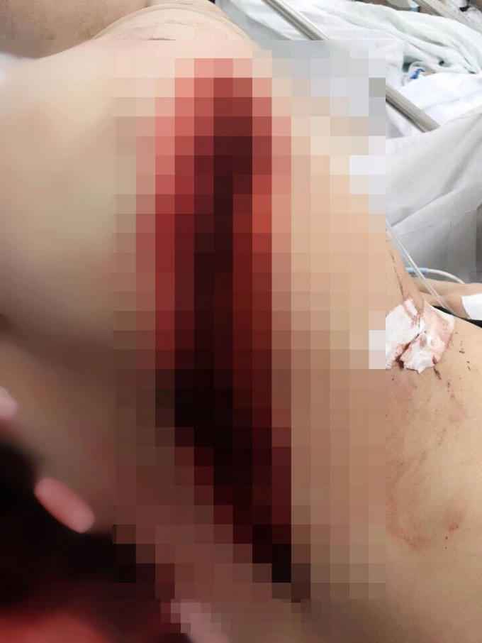 Anh Tuấn bị một số đối tượng dùng dao phóng lợn chém gây thương tích rất nặng.