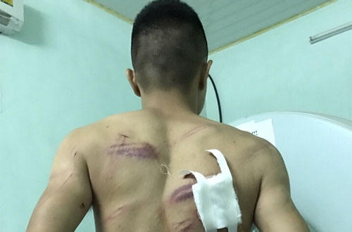 Anh Hưng với các vết thương sau trận truy sát giữa ban ngày.