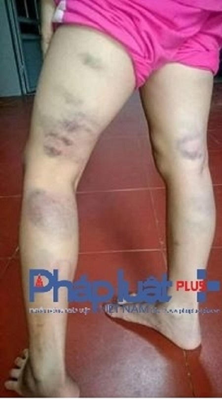 Chỉ vì viết sai một chữ mà em Lương Thị Anh T. bị cô giáo dạy dỗ bằng roi vọt... một cách không thương tiếc.