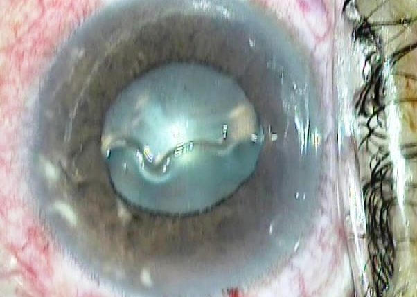 Hình ảnh con giun dài 14mm trong mắt bệnh nhân P.