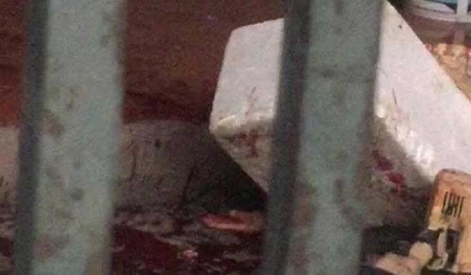 Bàn tay bị đứt rời của bà Thảo.