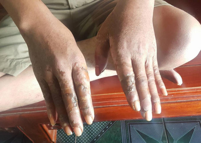 Những vết thương trên tay anh Trung do nhóm đối tượng gây ra.