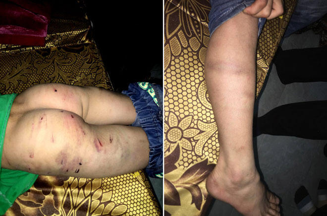 Bé trai 9 tuổi nghi bị bố đánh gãy răng, cơ thể chi chít vết thương.