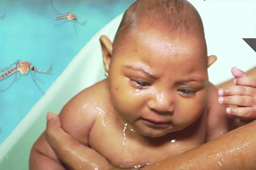 Một đứa trẻ bị dị tật đầu nhỏ do người mẹ nhiễm virus Zika khi mang thai. Ảnh: Health.