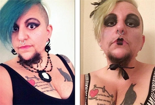 Người phụ nữ mắc hội chứng buống trứng đa nang nên râu mọc như đàn ông. Ảnh: News.