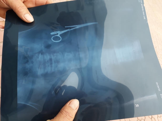 Hình dạng chiếc panh y tế bỏ quên trong bụng ông Nhật gần 20 năm qua phim X-quang.