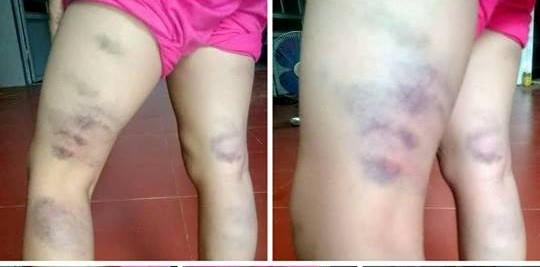 Hình ảnh hai chân bị thâm tím của học sinh bị cô  giáo đánh.