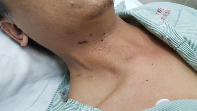 Một bên mắt, trên trán và phía dưới cổ có nhiều vết thương thâm tím.