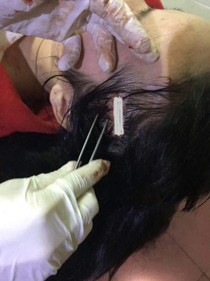 Vết thương ở đầu khiến chị Ngọc phải khâu nhiều chục mũi.