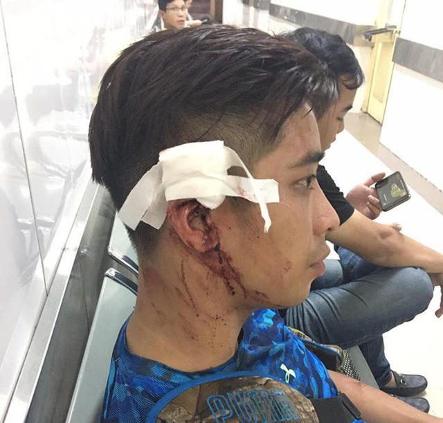 Tai anh D sau khi bị nhóm huấn luyện viên phòng tập Yoga hành hung.