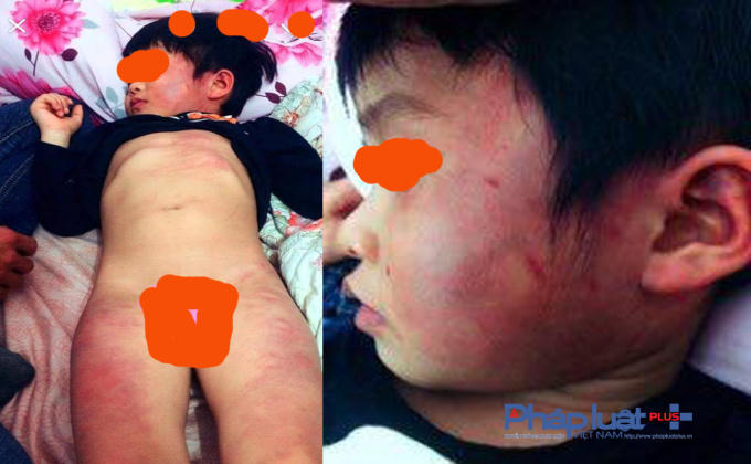 Cháu L.T.D bị bạn trong lớp đánh dẫn đến thâm tím toàn cơ thể.