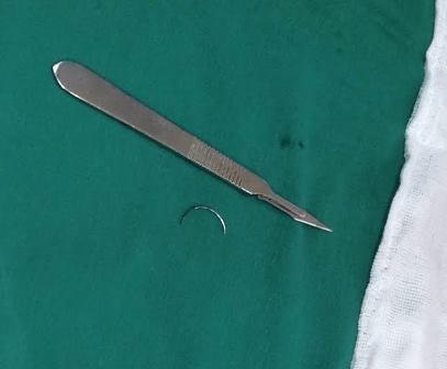 Cái kim có hình dạng cong, một đầu nhọn nằm trong bụng bệnh nhân T. suốt 15 năm qua.