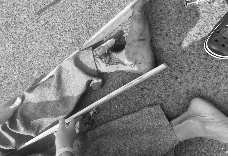 Vụ tai nạn khiến nạn nhân bị gãy hở xương, nhưng phương tiện gây tai nạn đã rời khỏi hiện trường. (ảnh đương sự cung cấp). 