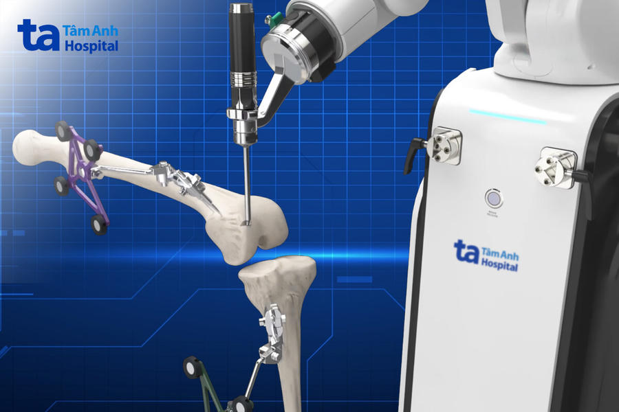 Cánh tay Robot CUVIS-Joint chủ động cắt xương chuẩn xác từng milimet theo kế hoạch. (Ảnh: BVCC)