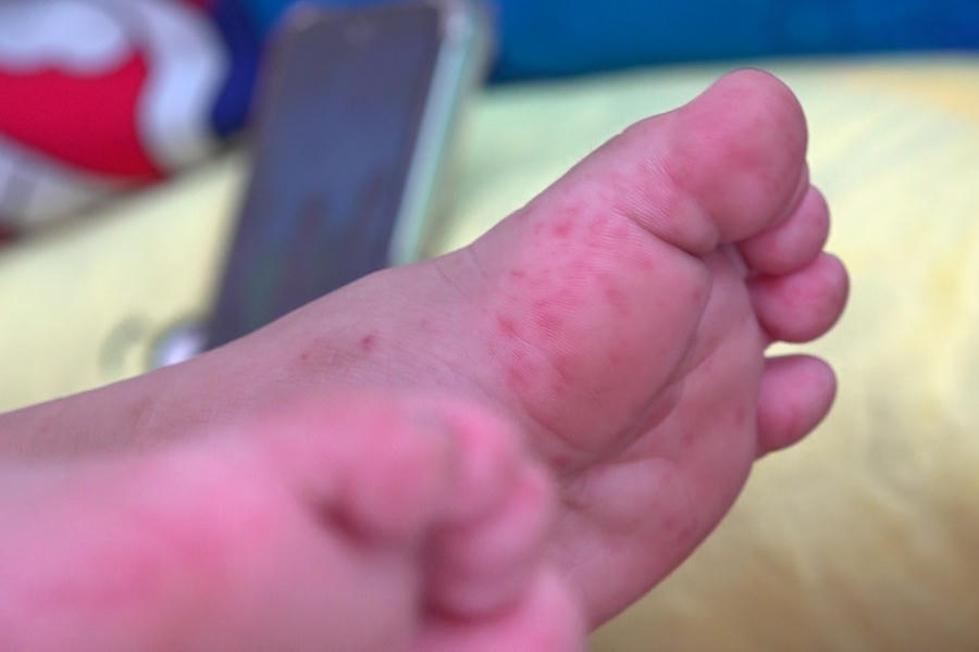 Vai trò của y tế học đường là "pháo đài" ngăn chặn nguồn lây&nbsp;bệnh tay chân miệng. (Ảnh: Tạ Quang)