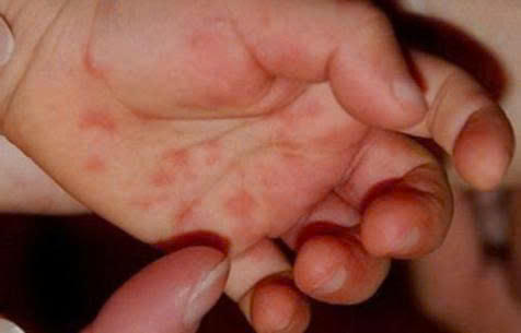 Hà Nội ghi nhận 275 ca tay chân miệng trong một tuần.